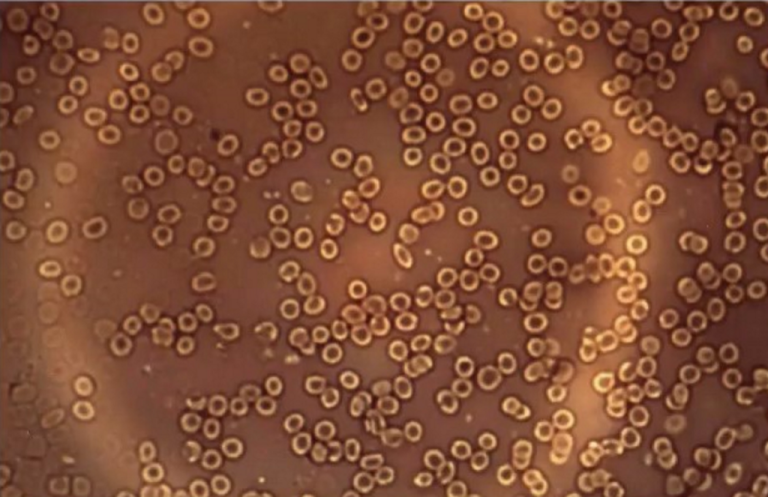 As novas evidências sobre os transtornos mentais dos vacinados e sobre o seu sangue modificado. 6